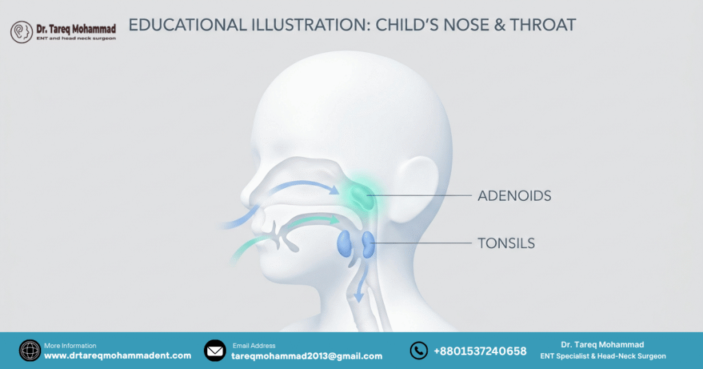 Adenoids sit behind the nose; tonsils sit at the back of the throat