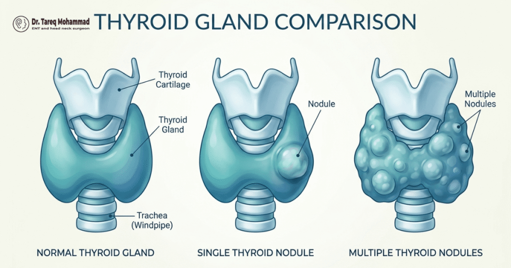 Comparison of a normal thyroid gland, a single nodule and multiple nodules
